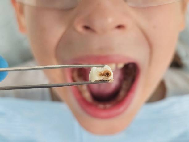 Best Broken or Cracked Tooth Emergency Dentist in Hammond, IN